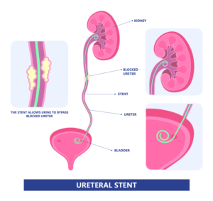 ureteral stent chart.